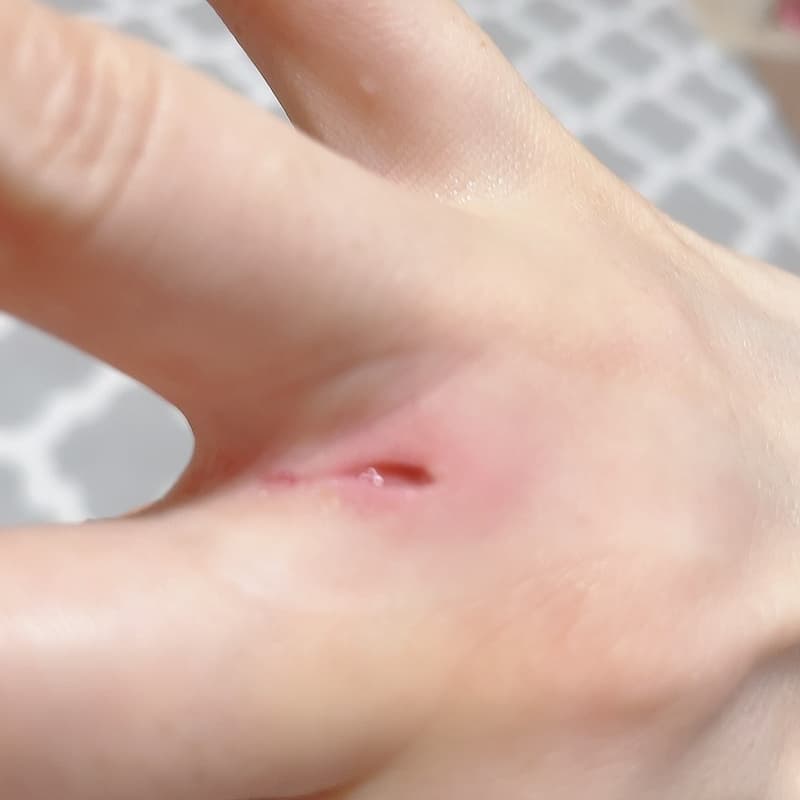 猫に傷つけられた手