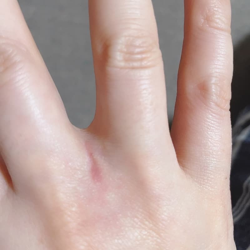 猫に傷つけられた手が回復してきたところ